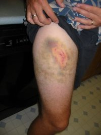 Random family photos contusion hit a tree